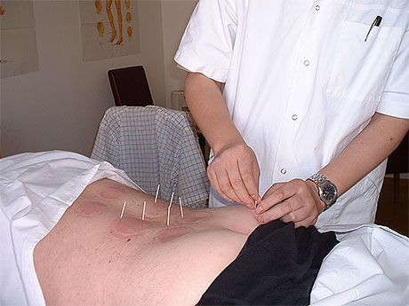 acupuncture1