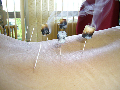 moxibustion2